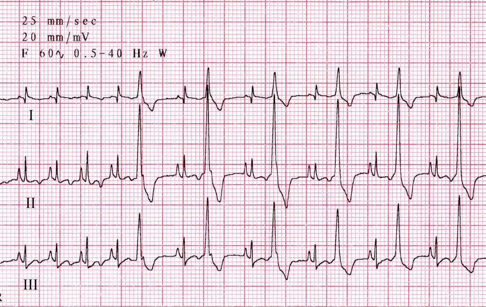 ecg practice test with answers